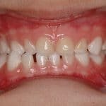 periodontal diseases