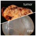 Cyst vs tumor