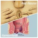 Heamorrhoids vs anal fissures