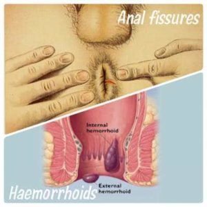 acrochordons hemorrhoids Anal vs