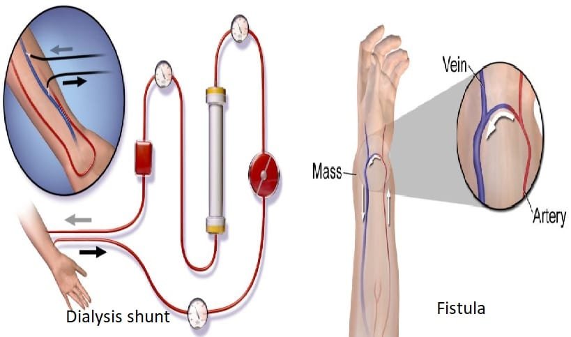difference-between-dialysis-shunt-and-fistula-lorecentral