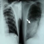 pneumonia and tuberculosis chest x rays