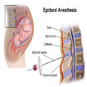 Epidural_Anesthesia